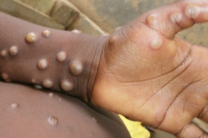 Trois cas de l'épidémie de Monkeypox détectés dans la zone de santé de N'Sele