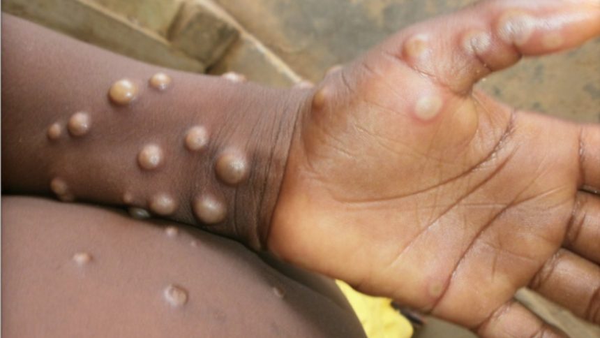 Trois cas de l'épidémie de Monkeypox détectés dans la zone de santé de N'Sele
